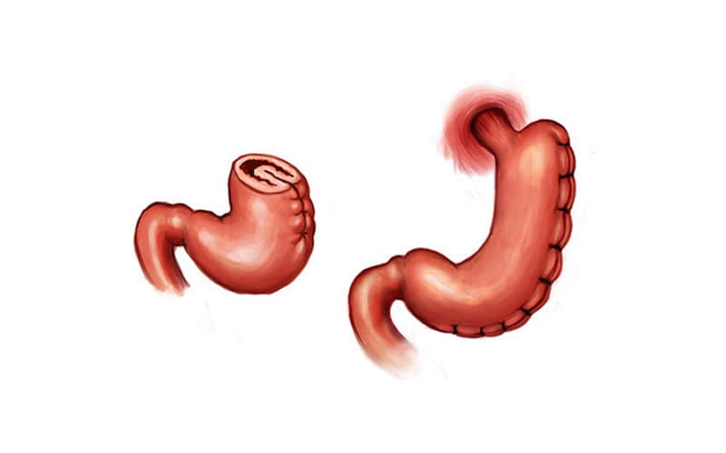 How Is Gastric Folding Surgery Performed