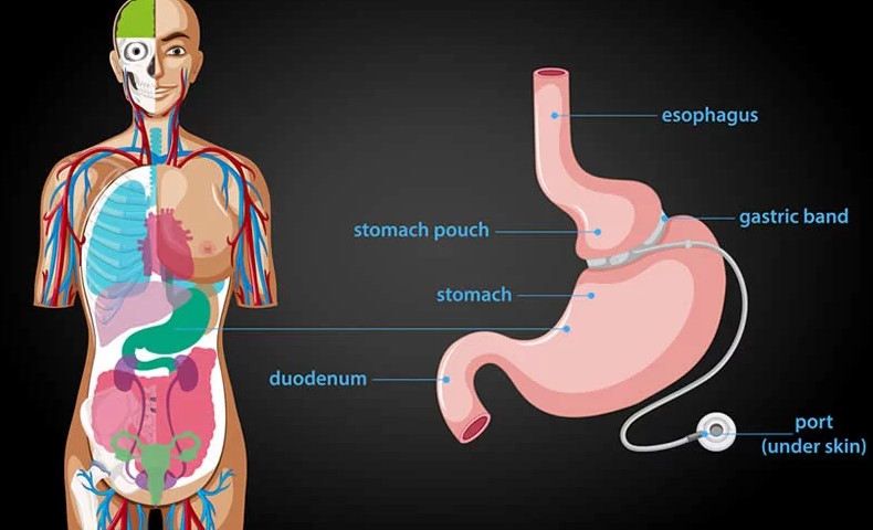 stomach band to gastric